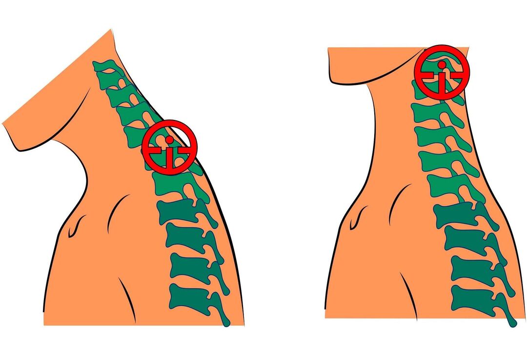 dzemdes kakla osteohondroze