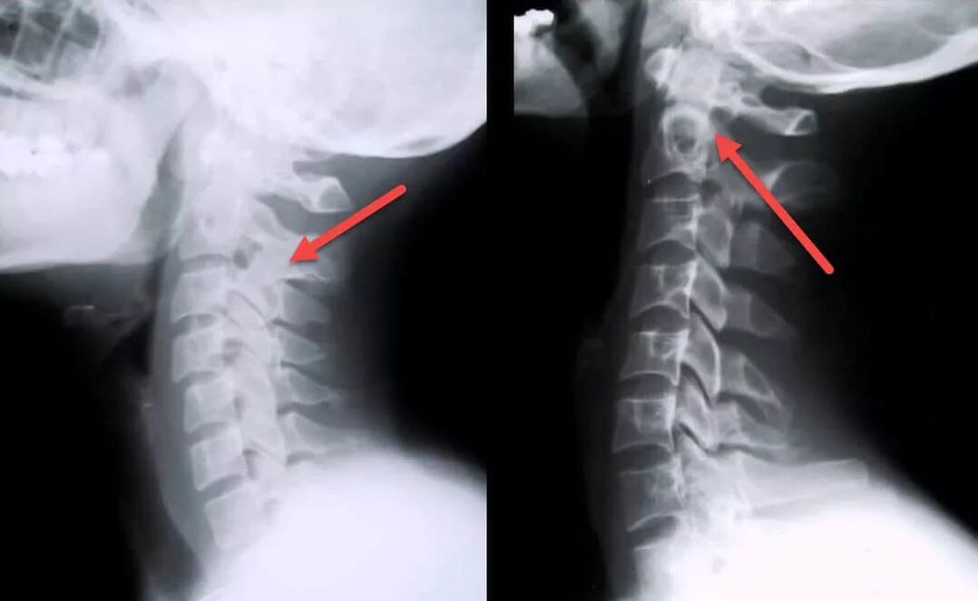 dzemdes kakla osteohondrozes diagnostika