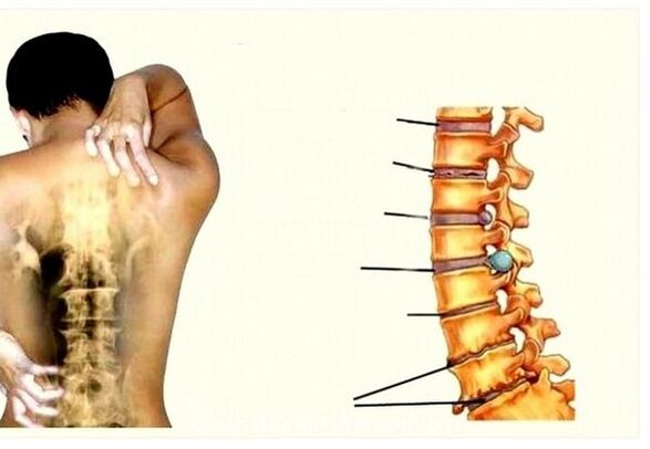 Dzemdes kakla osteohondrozes posmi
