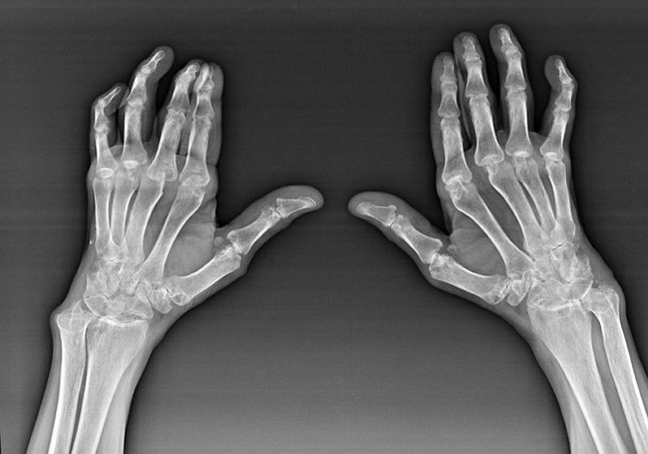 Pirkstu locītavu diagnostika