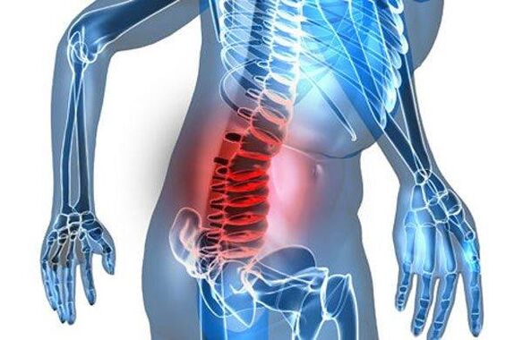 Mugurkaula deformācija jostas daļas osteohondrozes ceturtajā stadijā