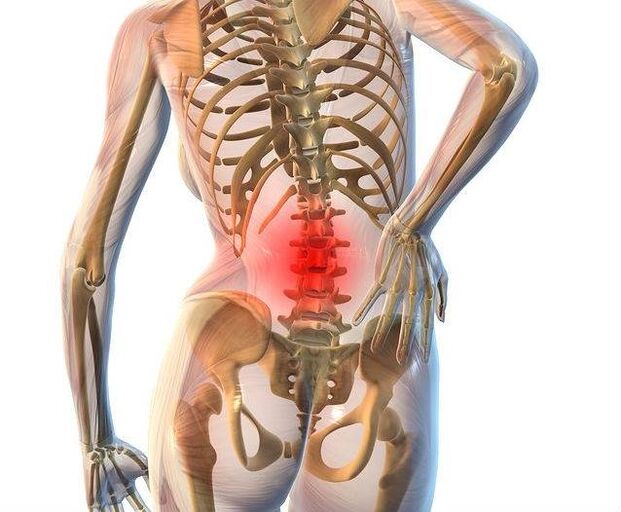 Mugurkaula jostas daļas osteohondroze
