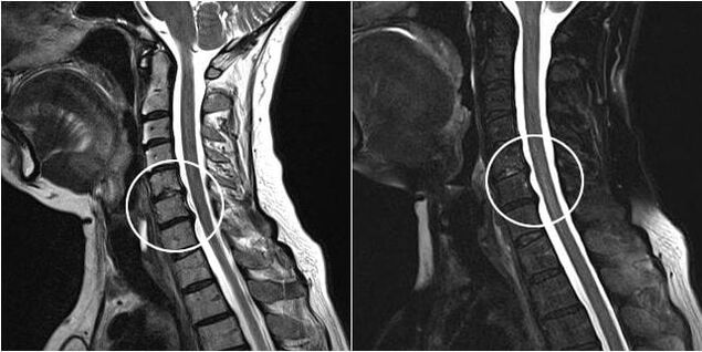 Mugurkaula kakla daļas MRI ar osteohondrozes pazīmēm